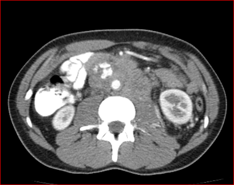 File:Burned-out testicular choriocarcinoma (Radiopaedia 32822-34040 B 11).PNG