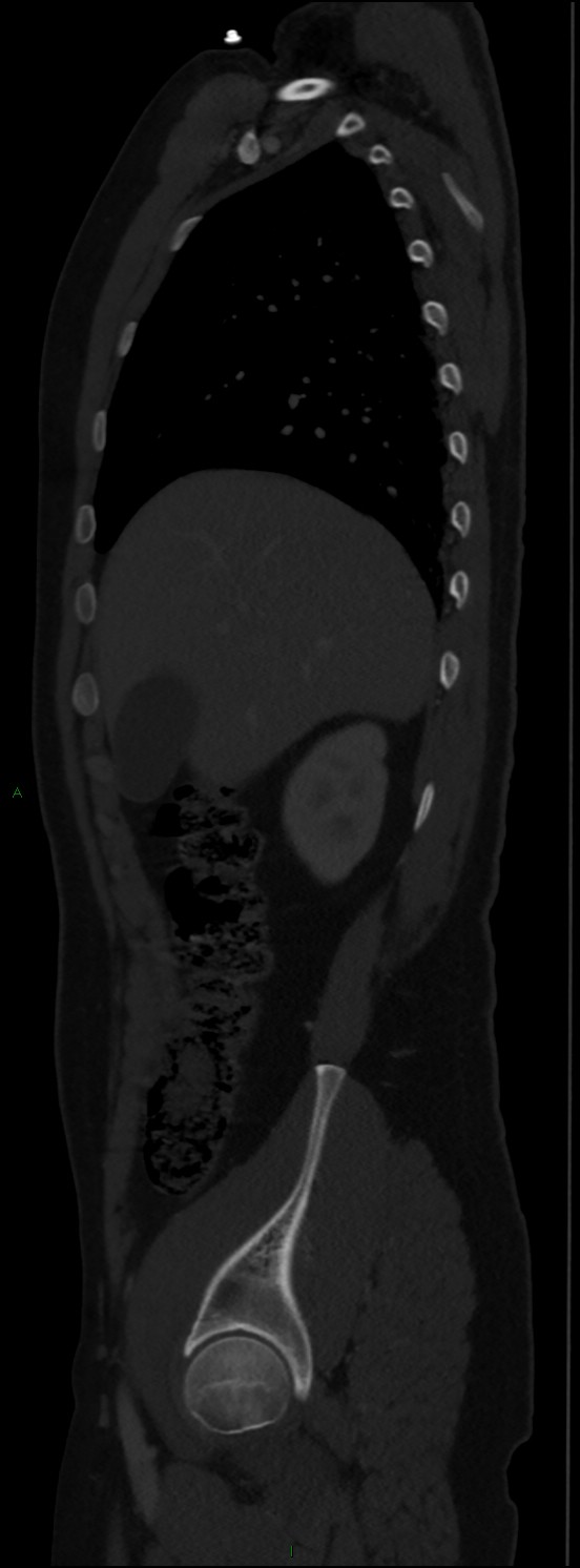 Burst fracture (Radiopaedia 83168-97542 Sagittal bone window 42).jpg