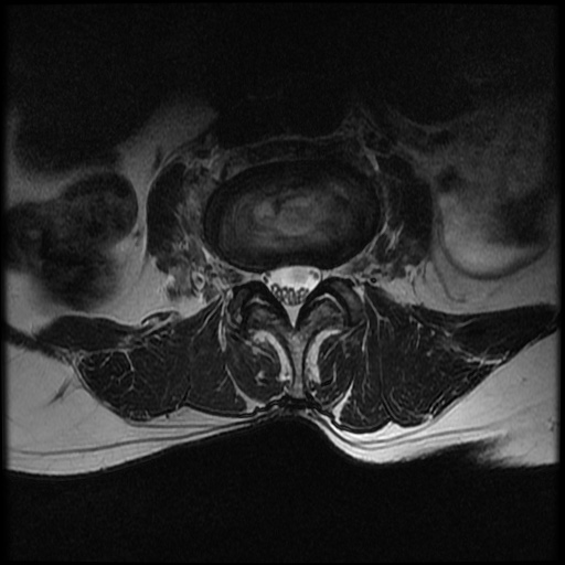 File:Burst fracture - lumbar spine (Radiopaedia 72877-83541 Axial T2 12).jpg