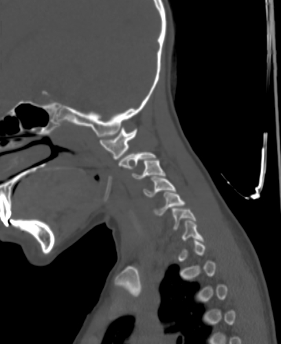 Butterfly vertebra (Radiopaedia 77903-90209 Sagittal bone window 10).jpg