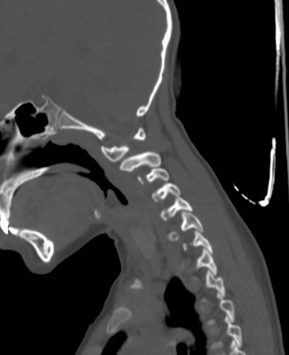 File:Butterfly vertebra (Radiopaedia 77903-90209 Sagittal bone window 22).jpg