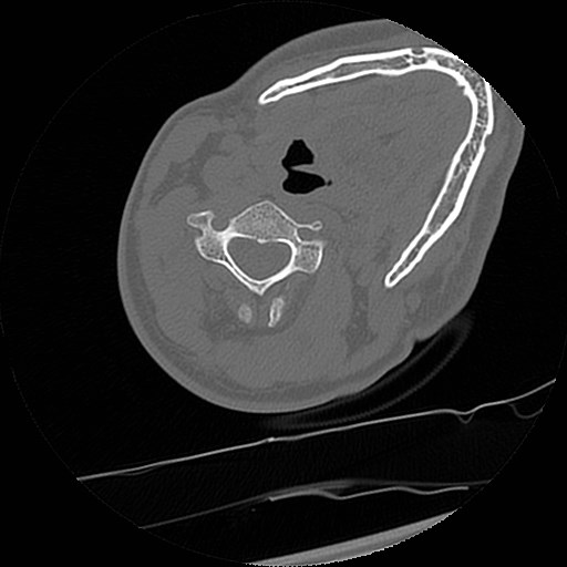 C1-C2 "subluxation" - normal cervical anatomy at maximum head rotation (Radiopaedia 42483-45607 Axial non-contrast 20).jpg