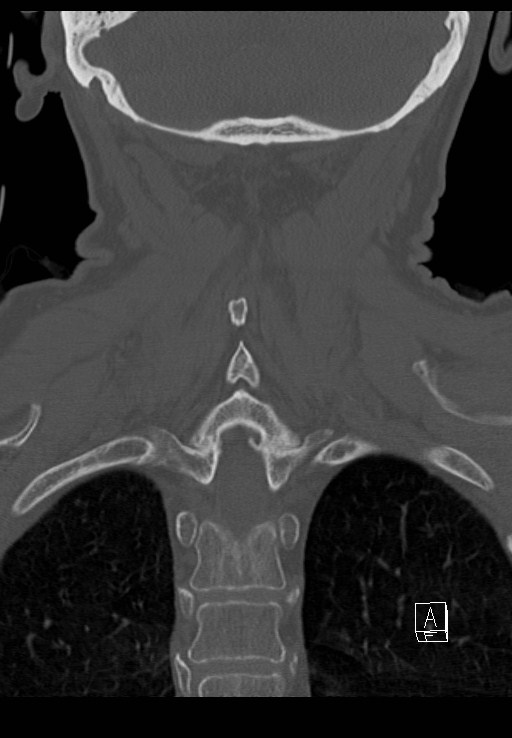 C1 and C2 (peg) fractures (Radiopaedia 36618-38184 Coronal bone window 40).jpg