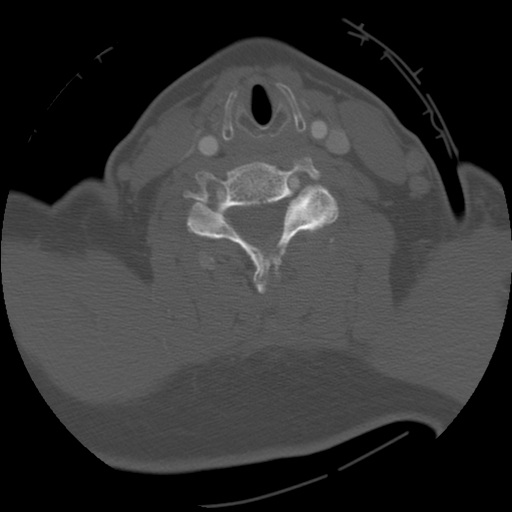 File:C1 anterior arch (plough) fracture - type 1 (Radiopaedia 76181-87720 Axial bone window 54).jpg