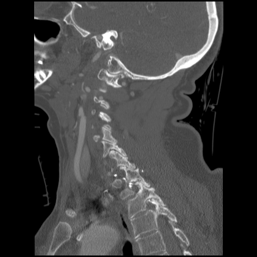 File:C1 anterior arch (plough) fracture - type 1 (Radiopaedia 76181-87720 Sagittal bone window 40).jpg