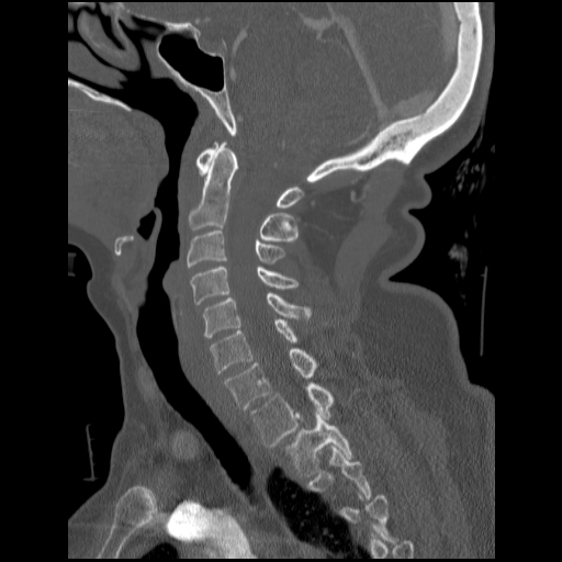 File:C1 anterior arch (plough) fracture - type 1 (Radiopaedia 76181-87720 Sagittal bone window 59).jpg