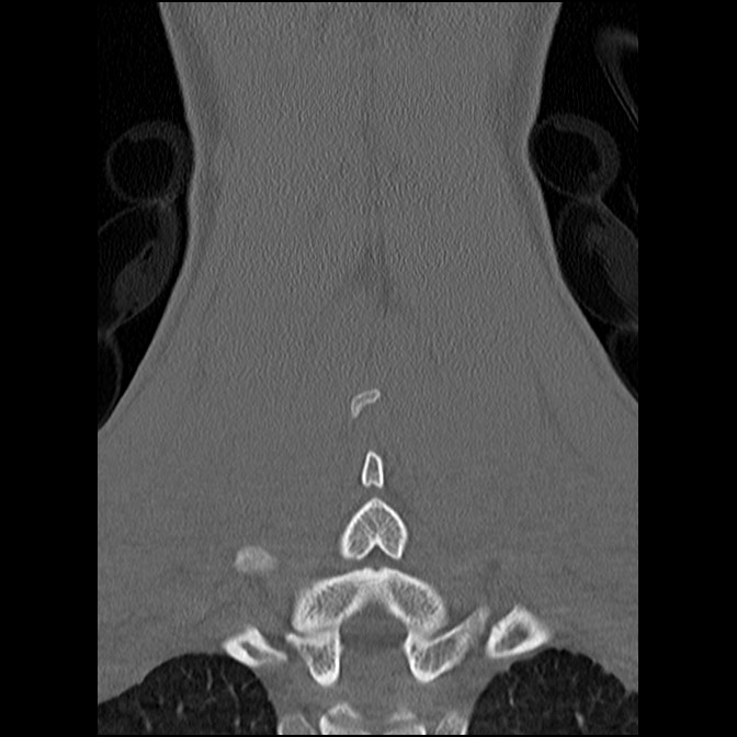 C5 facet fracture (Radiopaedia 58374-65499 Coronal bone window 47).jpg