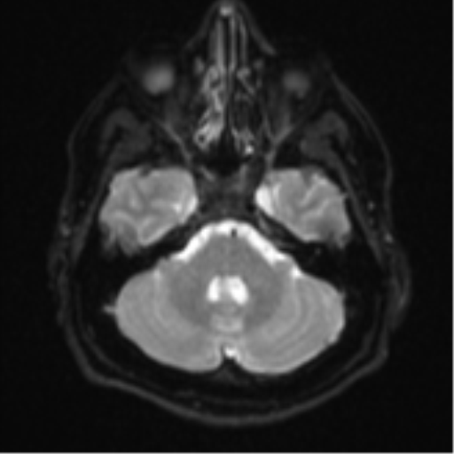 File:CNS vasculitis (Radiopaedia 55715-62263 Axial DWI 7).png