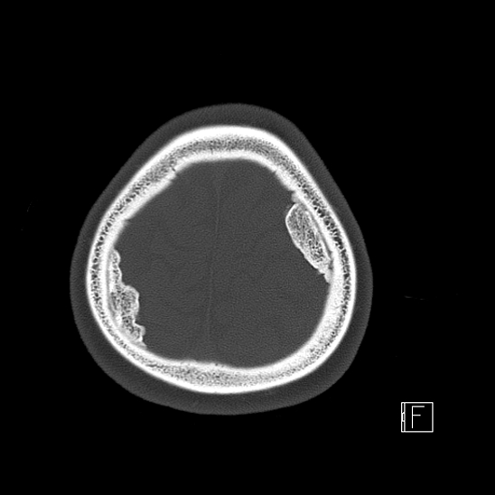 File:Calcified chronic subdural hematoma (Radiopaedia 77374-89492 Axial bone window 123).jpg