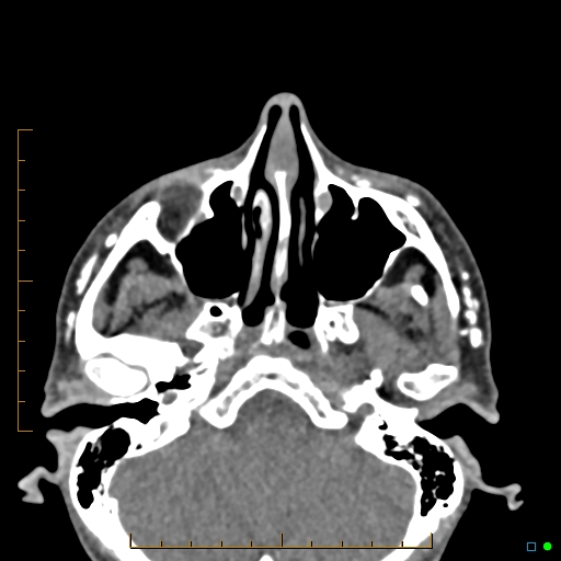 Calcified facial augmentation fillers (Radiopaedia 79514-92679 Axial non-contrast 17).jpg