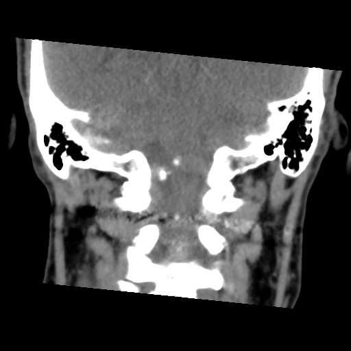 Calcifying pseudoneoplasm of neuraxis (Radiopaedia 44076-47617 Coronal non-contrast 29).png