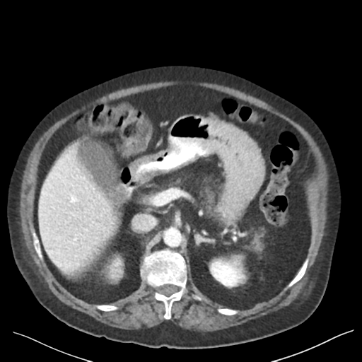 Cannonball metastases from endometrial cancer (Radiopaedia 42003-45031 E 27).png
