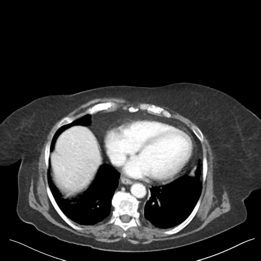 Cannonball metastases from endometrial cancer (Radiopaedia 42003-45031 E 8).png
