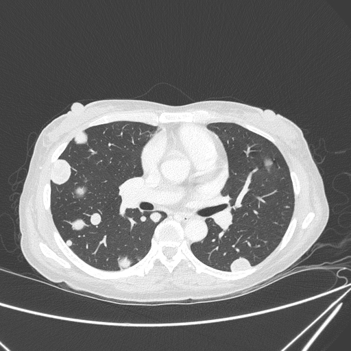 Canonball lung metastasis (Radiopaedia 77634-89837 Axial lung window 86).jpg