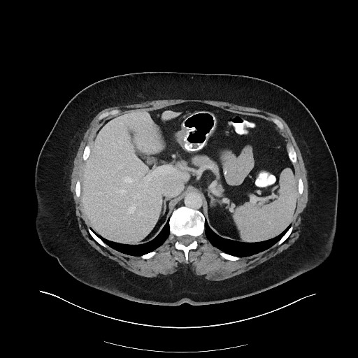 Carcinoid tumor - terminal ileum (Radiopaedia 60931-68739 A 34).jpg