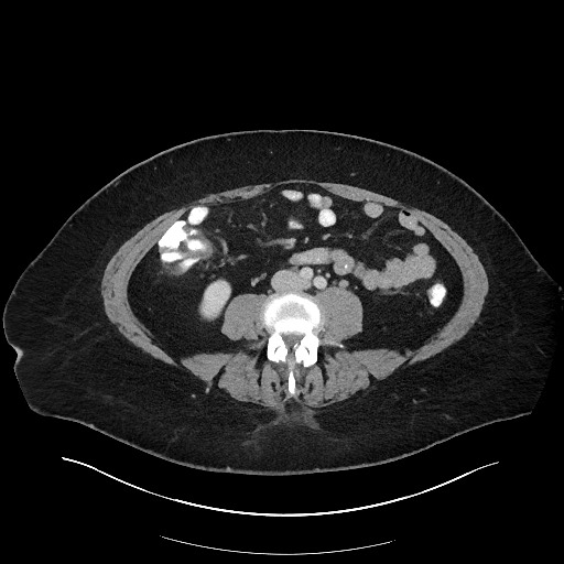 File:Carcinoid tumor - terminal ileum (Radiopaedia 60931-68739 Axial 18).jpg