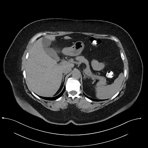 File:Carcinoid tumor - terminal ileum (Radiopaedia 60931-68740 Axial non-contrast 23).jpg