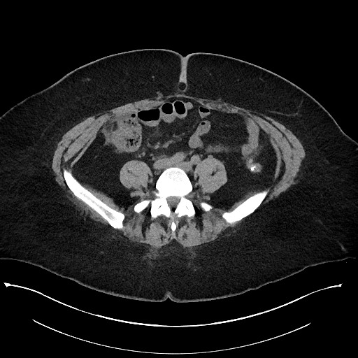 File:Carcinoid tumor - terminal ileum (Radiopaedia 60931-68740 Axial non-contrast 76).jpg