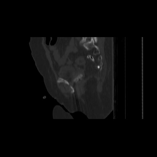 Carcinoma cervix- brachytherapy applicator (Radiopaedia 33135-34173 Sagittal bone window 116).jpg