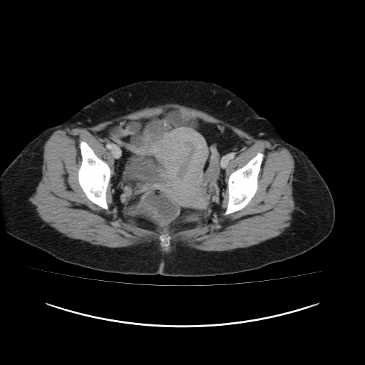 Carcinoma colon - hepatic flexure (Radiopaedia 19461-19493 A 116).jpg