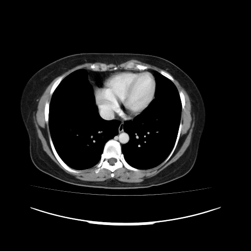 Carcinoma colon - hepatic flexure (Radiopaedia 19461-19493 A 9).jpg