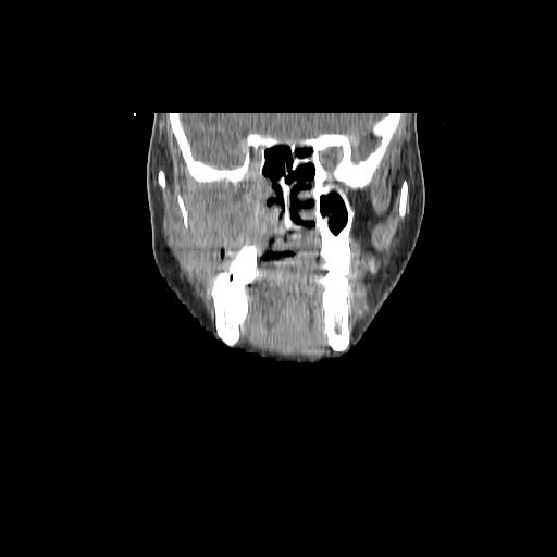 Carcinoma of the maxillary antrum (Radiopaedia 53805-59888 Coronal C+ delayed 51).jpg