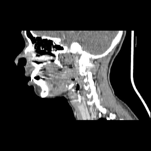 Carcinoma of the maxillary antrum (Radiopaedia 53805-59888 Sagittal C+ delayed 114).jpg