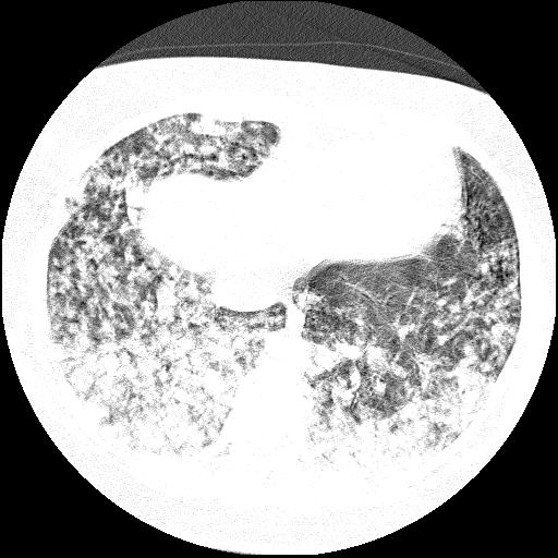 Cardiac angiosarcoma (Radiopaedia 66010-75181 Axial lung window 22).jpg