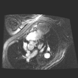 File:Cardiac fibroma (Radiopaedia 38974-41150 4 chamber FGRET 20).jpg