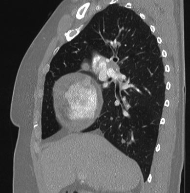 File:Cardiac sarcoidosis (Radiopaedia 74548-85534 Sagittal lung window 60).jpg