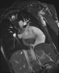 File:Cardiac tumor - undifferentiated pleomorphic sarcoma (Radiopaedia 45844-50136 Oblique T2 14).png