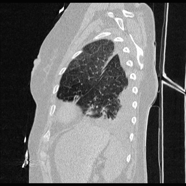 Cardiogenic pulmonary edema (Radiopaedia 29213-29609 Sagittal lung window 79).jpg