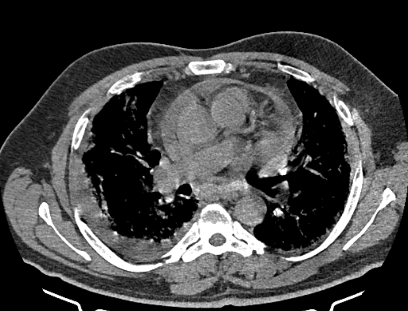 Cardiogenic pulmonary edema (Radiopaedia 68180-77678 Axial non-contrast 23).jpg