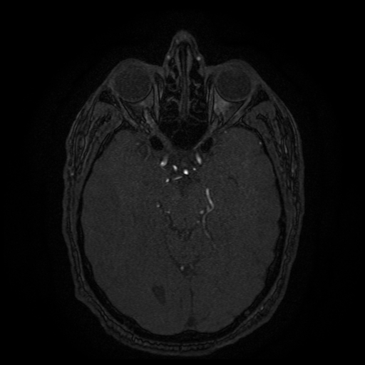 Carotid arterial dissection with acute cerebral infarction (Radiopaedia 26636-26784 MRA 101).jpg