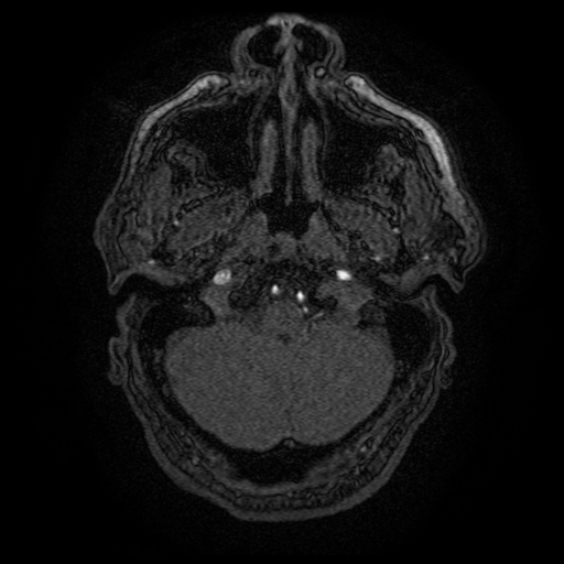 File:Carotid arterial dissection with acute cerebral infarction (Radiopaedia 26636-26784 MRA 152).jpg