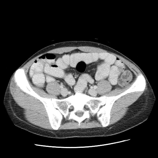 File:Castleman disease with fibrous pseudotumor in the abdomen (Radiopaedia 77296-89373 Axial 36).jpg