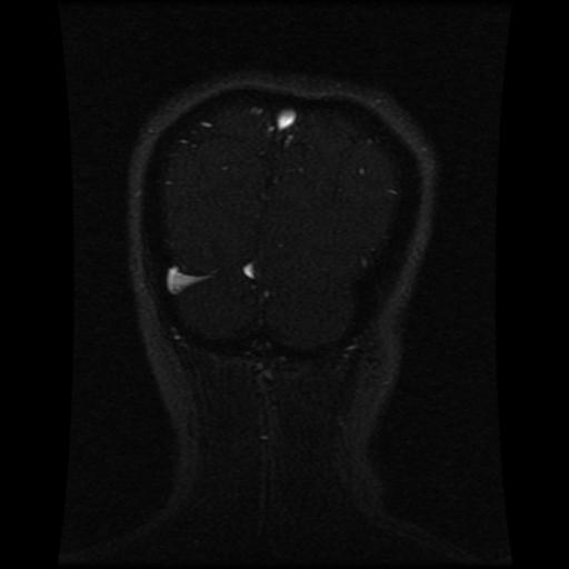 File:Cavernoma with developmental venous anomaly (Radiopaedia 22470-22507 MRV 33).jpg