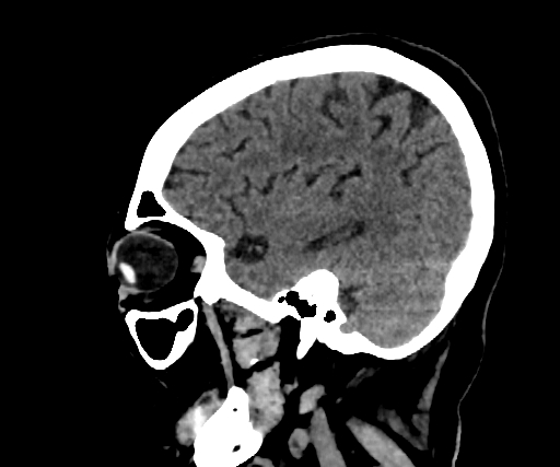 Cavernous hemangioma of the cerebellar falx (Radiopaedia 73025-83723 B 243).jpg