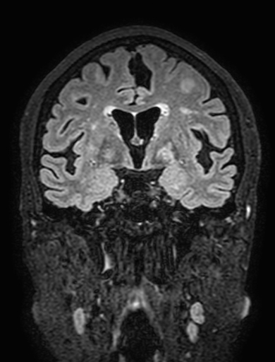 Cavernous hemangioma of the cerebellar falx (Radiopaedia 73025-83724 Coronal FLAIR 155).jpg