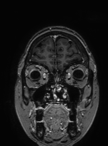 Cavernous hemangioma of the cerebellar falx (Radiopaedia 73025-83724 Coronal T1 C+ 60).jpg