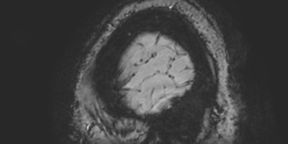 Cavernous hemangioma of the cerebellar falx (Radiopaedia 73025-83724 Sagittal BOLD 194).jpg
