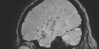 Cavernous hemangioma of the cerebellar falx (Radiopaedia 73025-83724 Sagittal BOLD 43).jpg