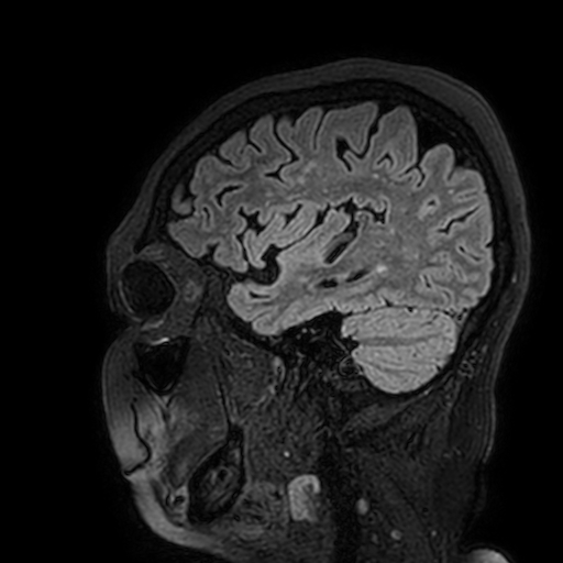 Cavernous hemangioma of the cerebellar falx (Radiopaedia 73025-83724 Sagittal FLAIR 170).jpg