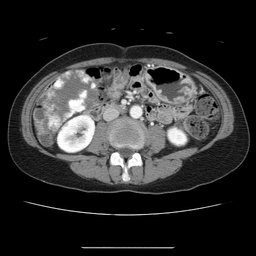 File:Cavernous hepatic hemangioma (Radiopaedia 75441-86667 B 60).jpg