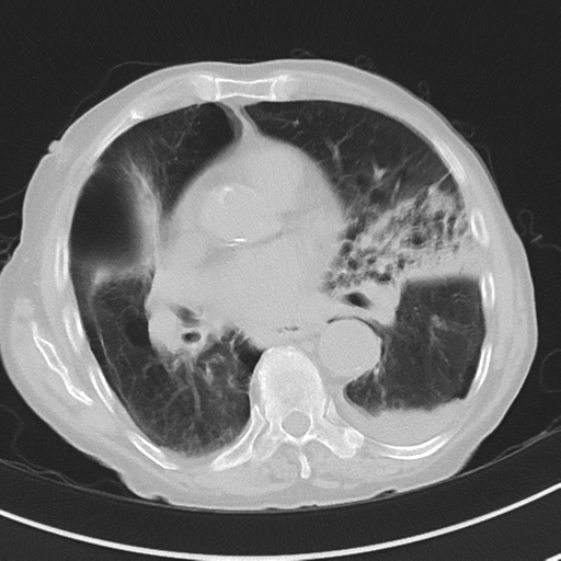 Cavitating pneumonia - lingular segments (Radiopaedia 34386-35678 Axial lung window 34).png