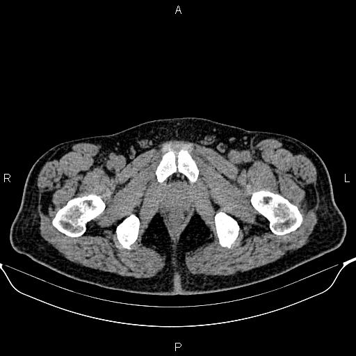 Cecal adenocarcinoma (Radiopaedia 85324-100916 Axial non-contrast 103).jpg