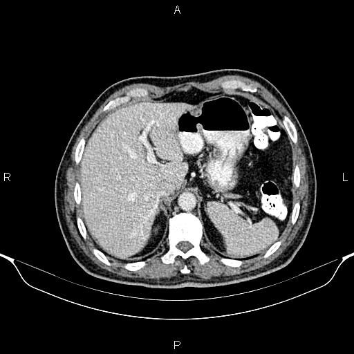 File:Cecal adenocarcinoma (Radiopaedia 85324-100916 B 19).jpg
