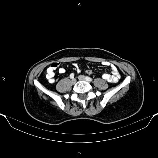 Cecal adenocarcinoma (Radiopaedia 85324-100916 B 65).jpg