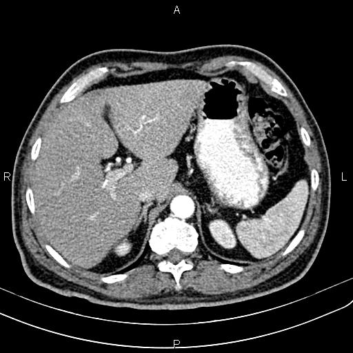 File:Cecal cancer with appendiceal mucocele (Radiopaedia 91080-108651 A 63).jpg
