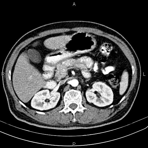 File:Cecal cancer with appendiceal mucocele (Radiopaedia 91080-108651 A 76).jpg
